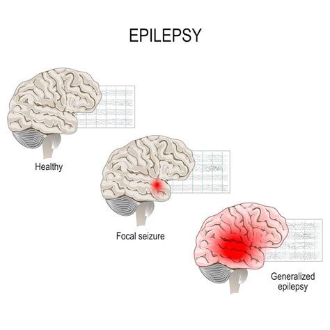 Symptomatic Epilepsy .